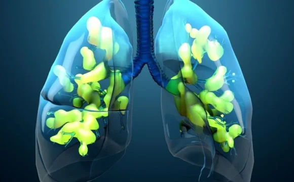 Insuficiența respiratorie acută