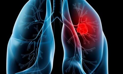 25a00a50c0acb13d2e72fdde6b9cde107767ee733e56184d3847e9abfe96f506 Cancer bronho-pulmonar