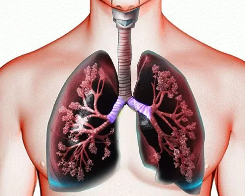 BPOC-Bronhopneumopatia-cronica-obstructiva BPOC – Bronhopneumopatie cronică obstructivă