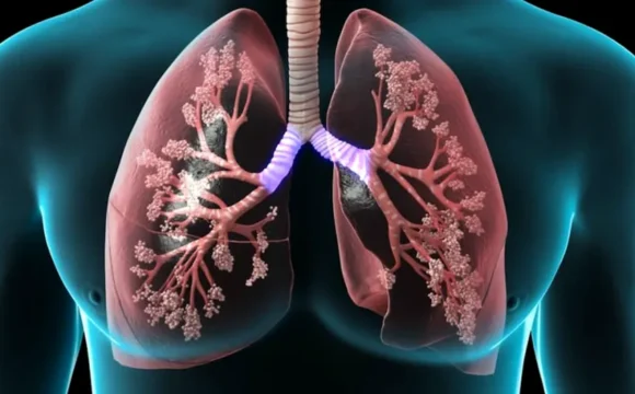 Edemul pulmonar acut