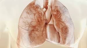 Manifestări pulmonare în colagenoze