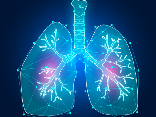 plaman-intrebarea-potrivita Tumori bronho-pulmonare