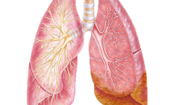 Mezoteliom pleural