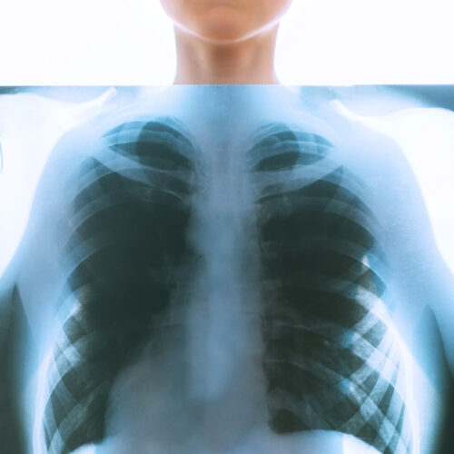suporatii Supurații pulmonare