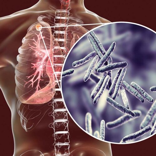 tbc Tuberculoza pulmonară și extrapulmonară